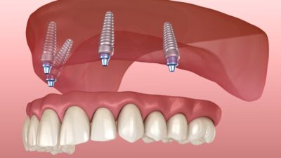 full mouth dental implants