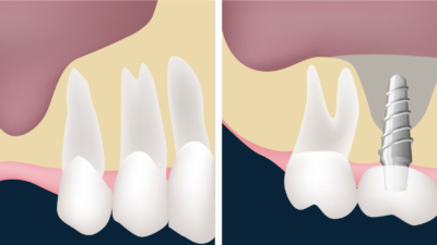 Extraction vs Dental Implant