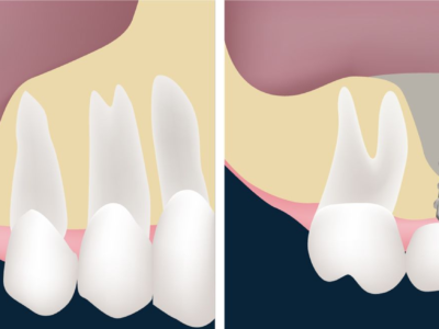 Extraction vs Dental Implant