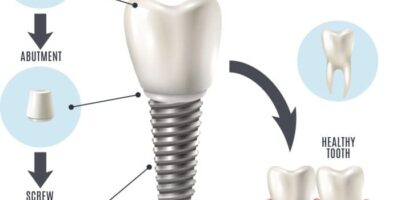 structure of teeth dental implants