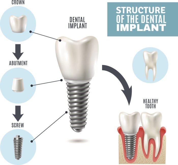 teeth-implant