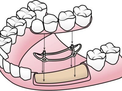 subperiosteal implant