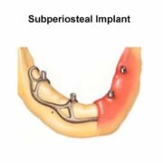 Subperiosteal Dental Implant: Procedure, Benefits and Risks Royal Dental Clinics subperiosteal implant