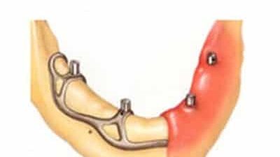 Subperiosteal Dental Implant: Procedure, Benefits and Risks Royal Dental Clinics Broken teeth subperiosteal implant