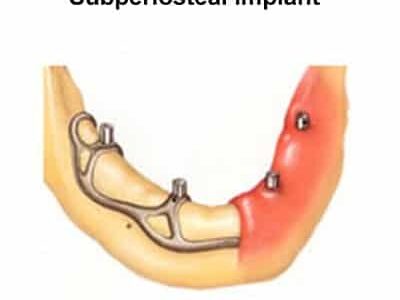 subperiosteal implant