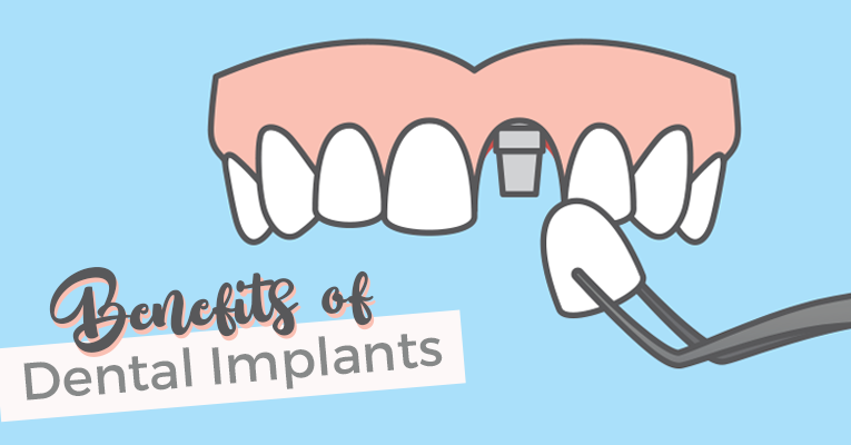 implant dentistry benefits