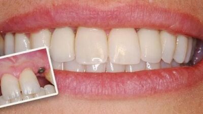 Teeth Dental Implants