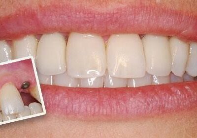 Teeth Dental Implants