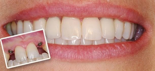 Teeth Dental Implants Trauma 
