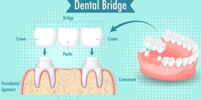 Dental bridges