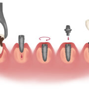 implant vs dental extraction
