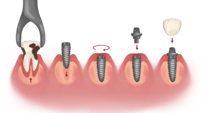 implant vs dental extraction