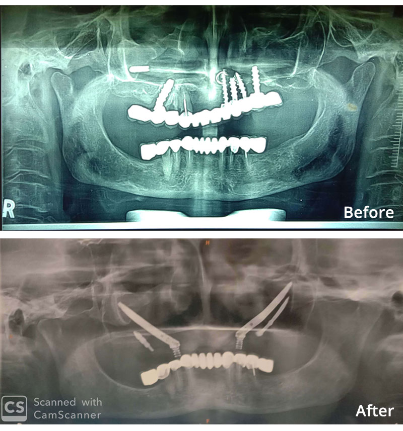 Zygomatic Dental Implant before After