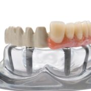 peek dental framework prosthodontics teeth