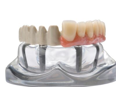 peek dental framework prosthodontics teeth