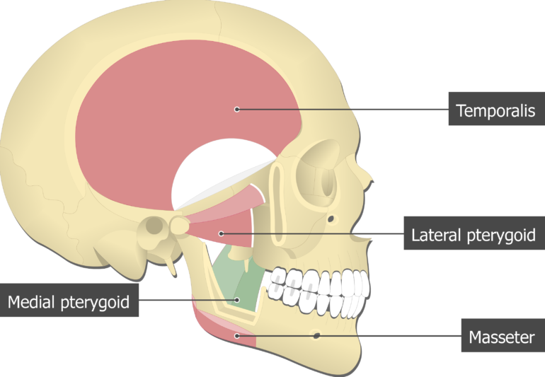 Pterygoid implant