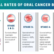 Is Stage 1 Mouth Cancer curable? Royal Dental Clinics stages 1 2 3 4 mouth cancer