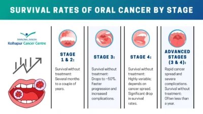 Is Stage 1 Mouth Cancer curable? Royal Dental Clinics Mouthwash Stages 1 2 3 4 mouth cancer