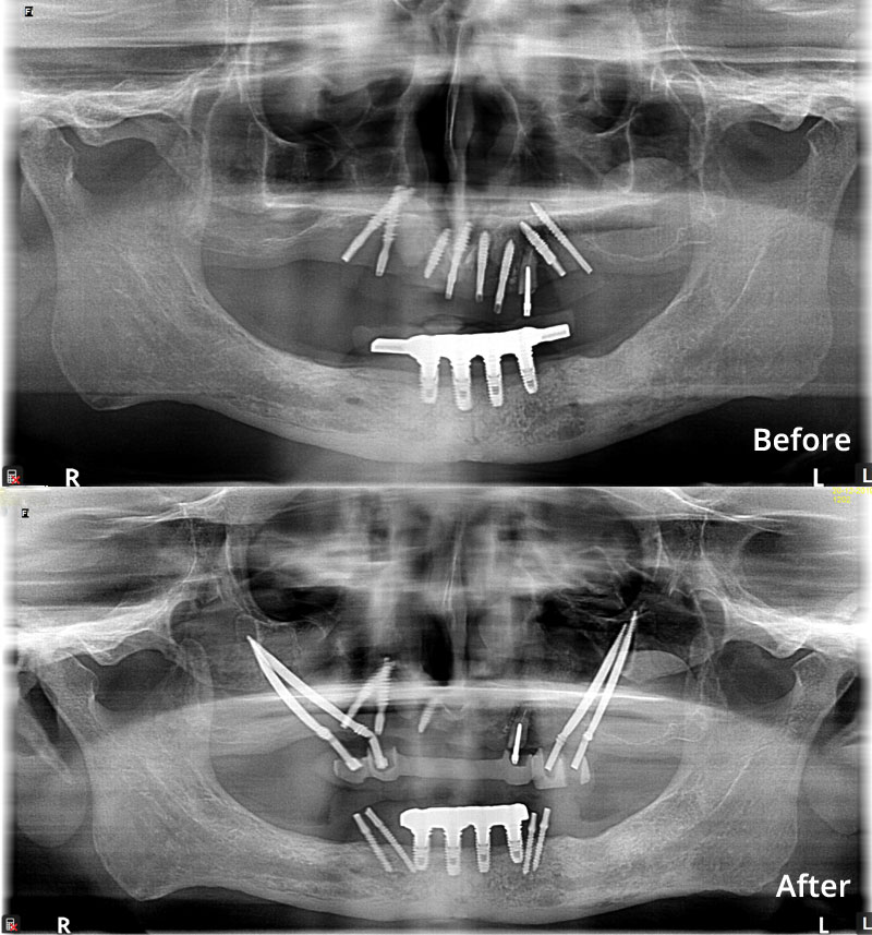 Zygomatic Implant In One Day
