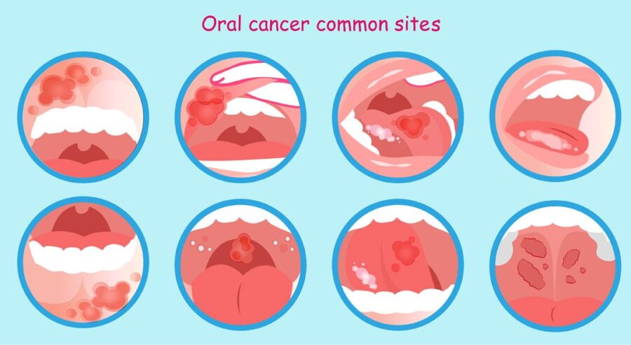 Oral Cancer in a Tooth? Mouth and Jaw Tumours Royal Dental Clinics Oral Cancer Symptoms - cancer in a tooth