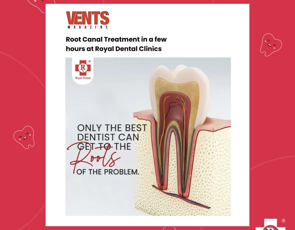 Root canal treatment Vents