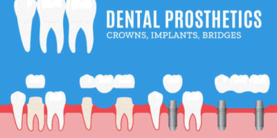 Prosthodontics dental crowns and bridges