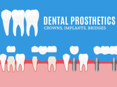 Prosthodontics dental crowns and bridges