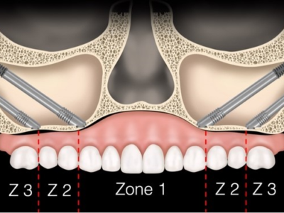 Zygomatic Dental Implant