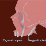 pterygoid and zygomatic dental implant