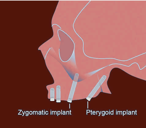 pterygoid and zygomatic dental implant