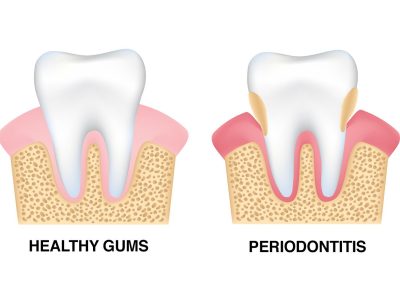 periodontal disease or periodontitis