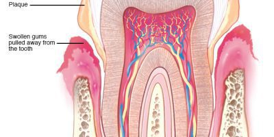 periodontal disease or periodontitis