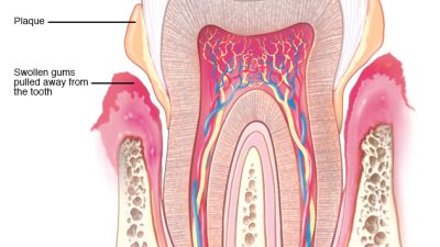 periodontal disease or periodontitis