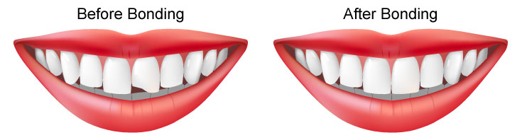 cosmetic bonding teeth in adolescence