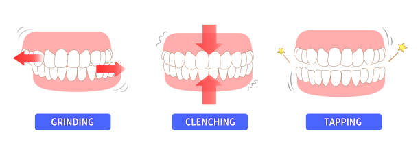 teeth clenching 
