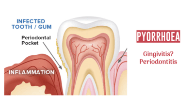 gingivitis gum disease