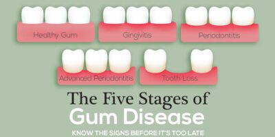 gingivitis and gum disease