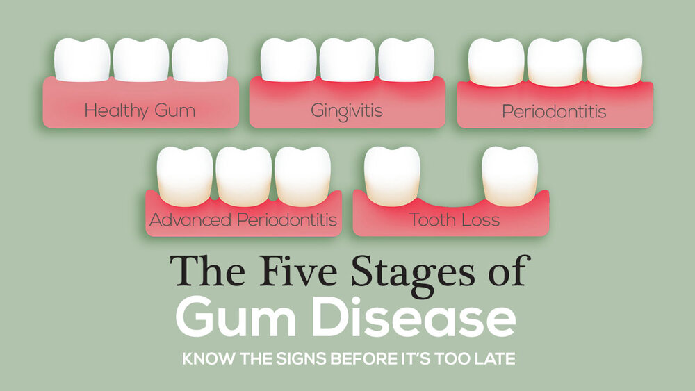gingivitis and gum disease