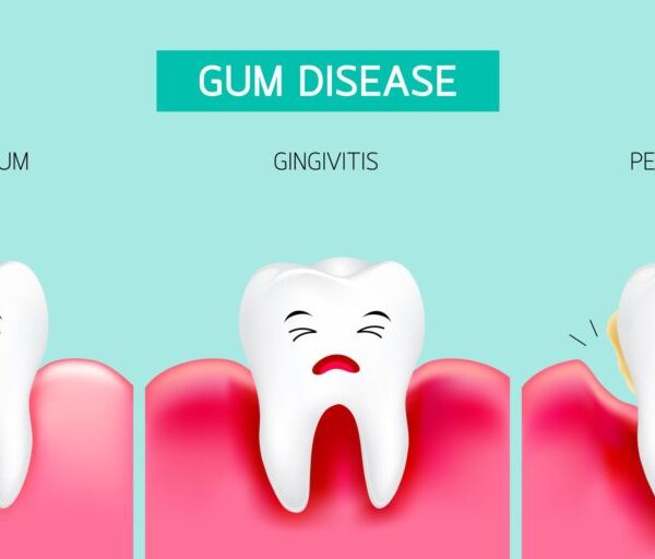 gum disease periodontal disease