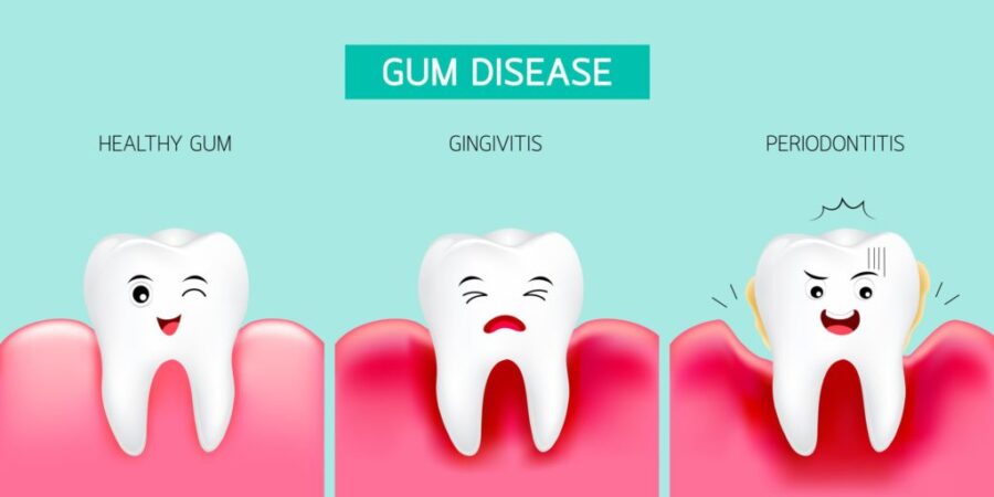 gum disease periodontal disease, dental care