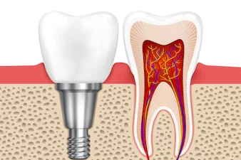 healthy-teeth-dental-implant-implant-tooth-health-tooth-medical-dentistry-vector-illustration_1284-46134