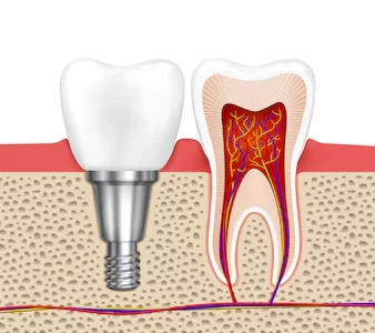 healthy-teeth-dental-implant-implant-tooth-health-tooth-medical-dentistry-vector-illustration_1284-46134