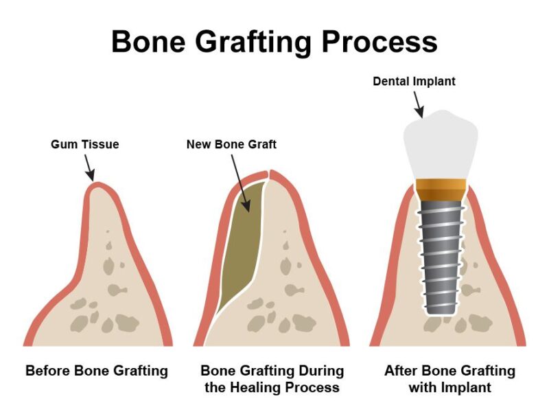 Bone_Grafting_Process