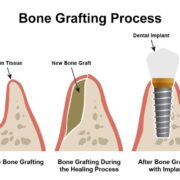 Bone_Grafting_Process