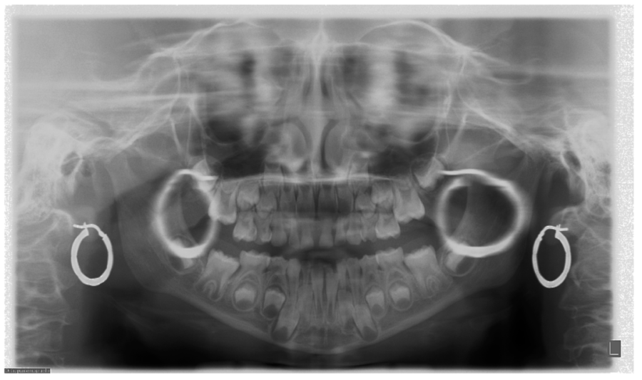 Jewellery in CBCT scan, Smiling Teeth Dental Clinic