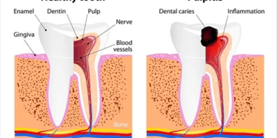 dental hyperaemia gums bleeding