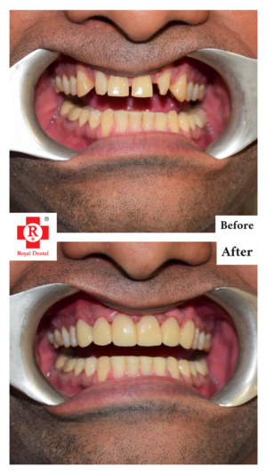 Front teeth Cosmetic Correction