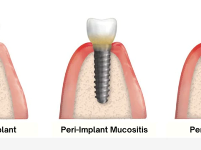 peri-implantitis implant infection