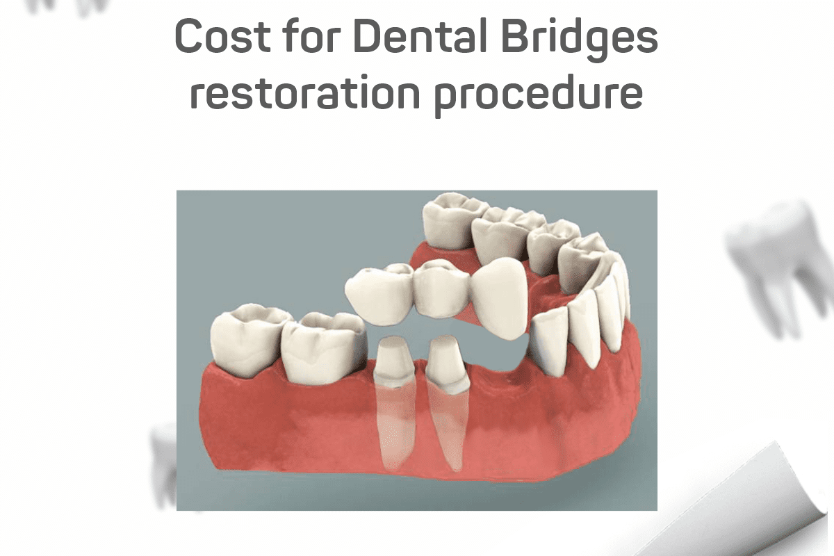 Cost of a Dental Bridge in India in 2024 Royal Dental Clinics cost of dental bridges in Inida