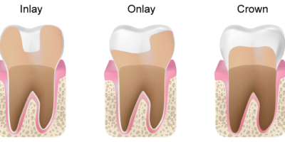 inlay and onlay dental filling